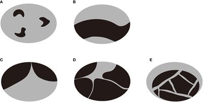 Development and validation of a nomogram model for predicting residue of partially cystic thyroid nodules after ultrasound-guided ethanol and thermal ablation